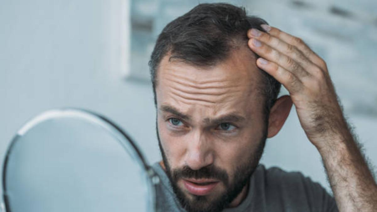 No solo por estrés: las 6 razones por las que podría quedarse calvo