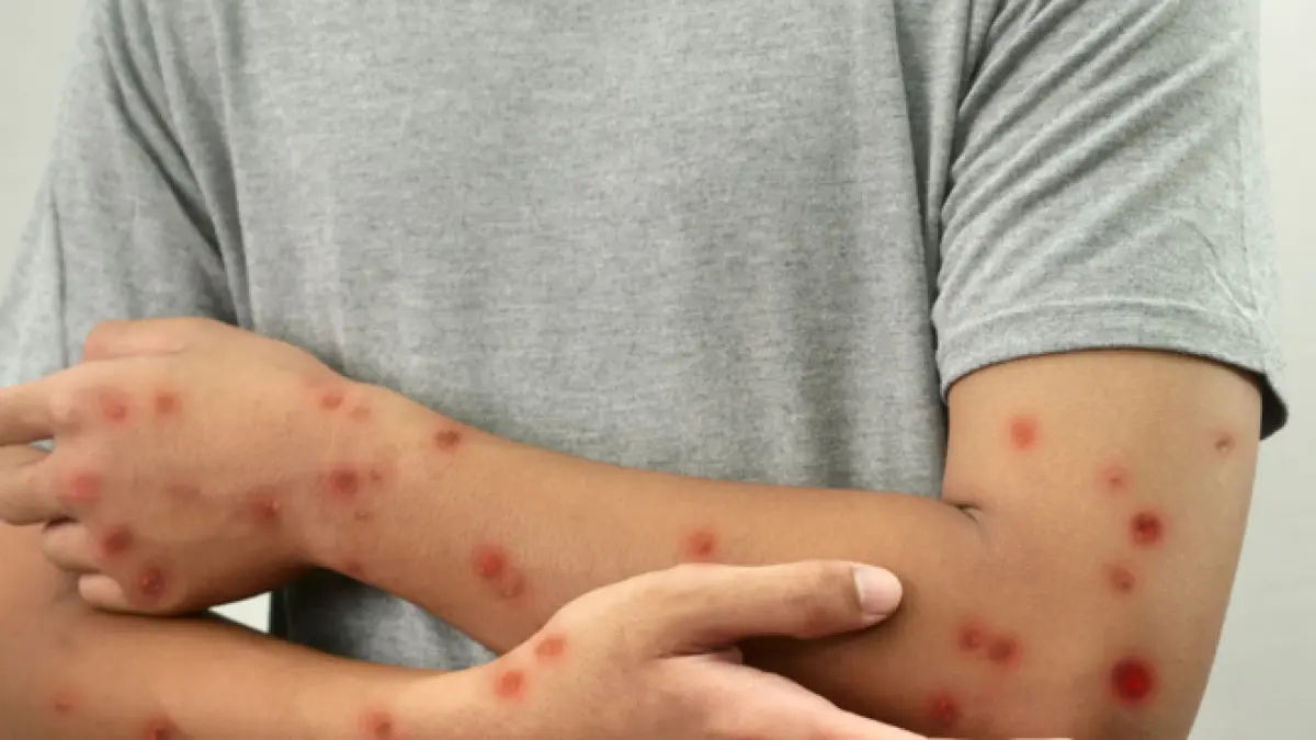 There are already 6 confirmed! Minsalud reveals a new case of measles in the country