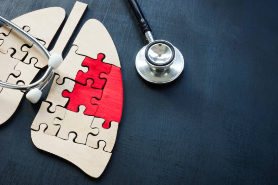El cáncer de pulmón es la principal causa de fatalidad por cáncer en Colombia y ocho de cada diez casos se diagnostican tardíamente.